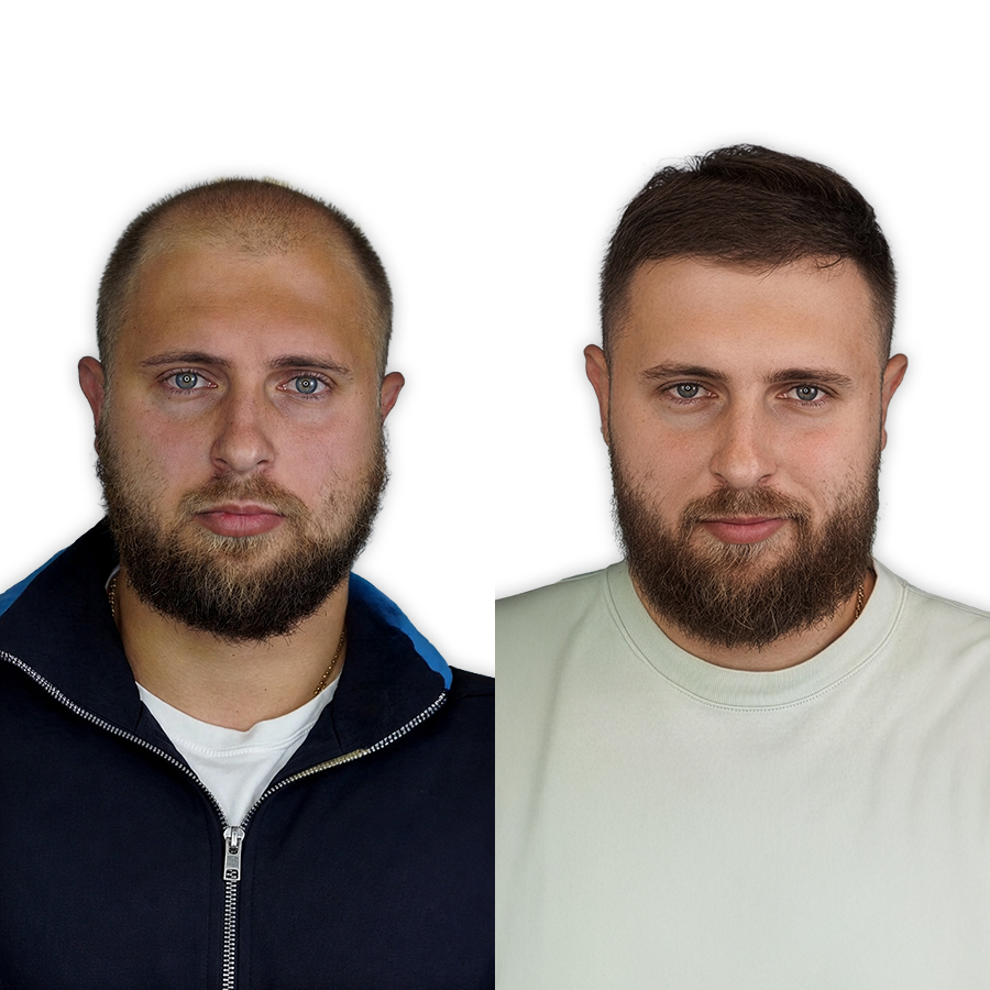 Before and after DHI — 5,000 grafts, patient from Madrid