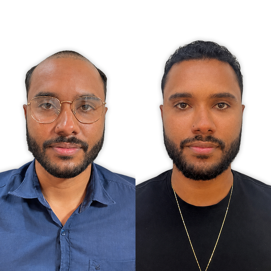 Before and after unshaven transplant — 4,000 grafts, patient from Sydney